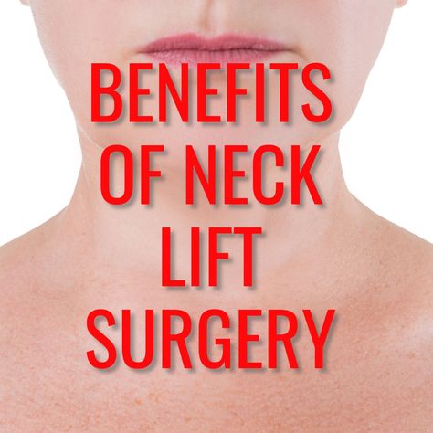 Natural Neck Lift, Neck Lift Before And After, Plastic Surgery Neck Lift, Chin Reduction Surgery, Lower Face And Neck Lift, Fox Eye Lift Surgery, Neck Lift Surgery, Body Surgery, Neck Tightening