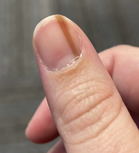 Subungual Melanoma: Tan Streak On Woman's Nail Was Skin Cancer Nail Room Ideas, Opal Nails, Nail Room, Nail Pictures, Popular Nail Designs, Nail Photos, Dark Nails, Get Nails, Brown Nails