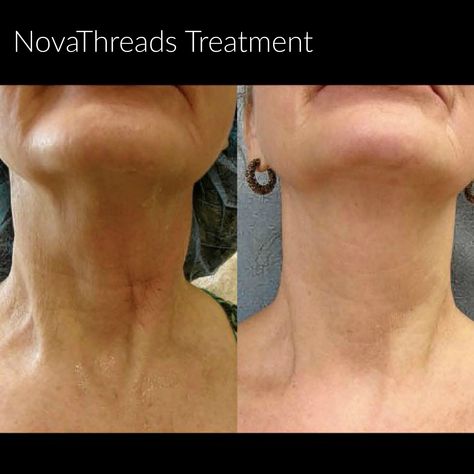 Neck Rejuvenation, Neck Tightening, Thread Lift, Girl Cool, New York Beauty, Facial Aesthetics, Neck Lift, Manhattan Ny, New Cosmetics