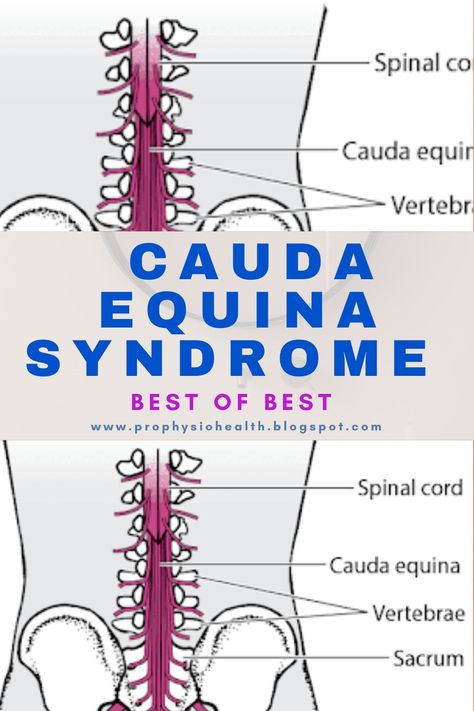 Complete detail about cauda equina syndrome | Physiotherapy | physiowork Cauda Equina, Neck And Back Pain, Back Pain Exercises, Spinal Cord, Doctor Medical, Back Pain, Medical, Health