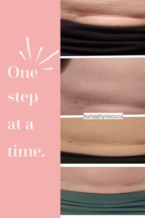 4 progressive images of a c-section scar becoming lighter; second photo is of c-section recovery kit (products) C Section Belly, C Section Scar, Scar Healing, C Section Scars, Ways To Heal, C Section Recovery, Pelvic Floor Dysfunction, Improve Mobility, Postpartum Belly