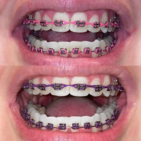 Dental Braces Colors, Braces Colors Combinations, Braces For Teeth, Pink Braces, Jewelry Teeth, Green Braces, Braces Colors Ideas, Braces And Glasses, Braces Food