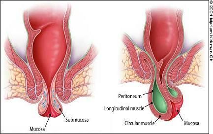 External Hemmoroids, Piles Remedies, Hemorrhoid Removal, Thrombosed Hemorrhoid, Rectal Prolapse, Hemorrhoid Remedies, Preparation H, Hemorrhoid Relief, Human Body Anatomy