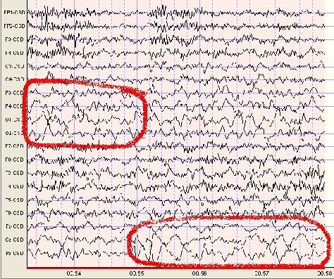 Delta waves are slow EEG waves that oscillate from about .5 to 4 times per second. Delta should generally be absent from the waking EEG records of adults. Focal Delta may be the result of a lesion or tumor or may indicate damage from a stroke. Delta Waves, Brain Mapping, Brain Waves, Night Shift, Brain, Vision Board, Candy