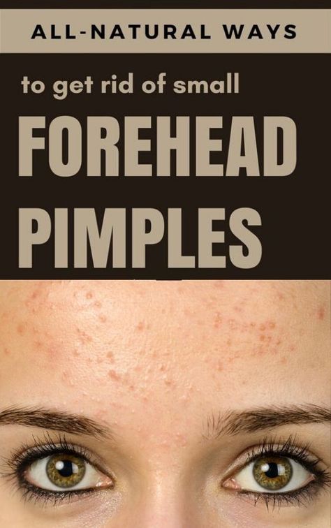 How to Get Rid Of Pimples on Forehead #beauty #beautyhacks #pimple #acne, #pimples #overnightpimples #removepimples #removepimplesovernight https://whispers-in-the-wind.com/combatting-pimples-under-the-skin-expert-tips-and-product-recommendations/?201 Get Rid Of Forehead Acne, Hard Pimple, Deep Pimple, Clear Acne Fast, Pimple Solution, Pimples On Forehead, Small Pimples, Face Mapping Acne, Get Rid Of Pimples