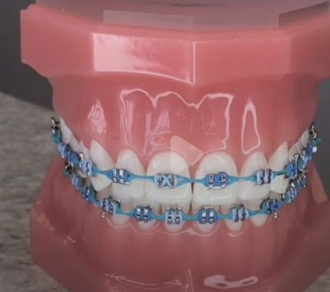 Bracket Color Ideas, Baby Blue Braces, Braces Combos, Brace Colors, Halloween Party Photos, Braces Colors Combinations, Blue Braces, Braces Colors Ideas, Braces Ideas