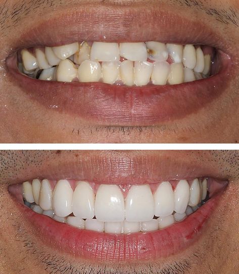 Teeth Makeover, Natural Veneers, Teeth Correction, Teeth Veneers, Baking Soda Teeth Whitening, Veneers Teeth, Bad Teeth, Crooked Teeth, Loose Tooth