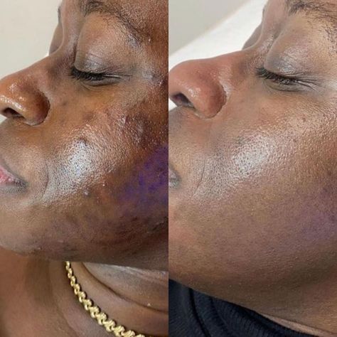 VI Peel & VI Derm (@vipeel) • Instagram photos and videos Vi Peel, Self Concept, Chemical Peel, Esthetician, Created By, Instagram Photos, Photo And Video, Instagram Photo, On Instagram