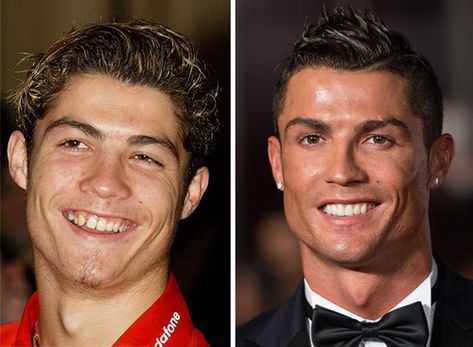 Cristiano Ronaldo Before And After Braces Celebrity Teeth, Braces Before And After, Bad Celebrity Plastic Surgery, After Braces, Dental Braces, Perfect Teeth, Teeth Braces, Celebrity Plastic Surgery, Celebrities Then And Now