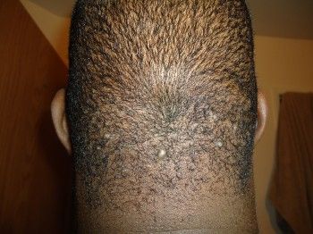 How To Get Rid Of Hair Bumps, Bump On Head, Razor Bumps Remedy, Hair Parts, Shaving Bumps, Natural Medicines, Bump Hairstyles, Head Bump, Chin Hair