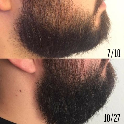 Monat Before And After, Regrow Hair, Beard Growth, Beard Oil, Facial Hair, Made In America, Healthy Hair, Mens Hairstyles, Facial