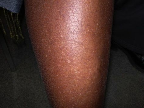 What are the white spots on my arms? What to know about 'reverse freckles' Moles On Face, Black Head Remover Mask, Spots On Legs, Skin Moles, Skin Spots, Spots On Face, Light Spots, Remove Dark Spots, Skin Discoloration