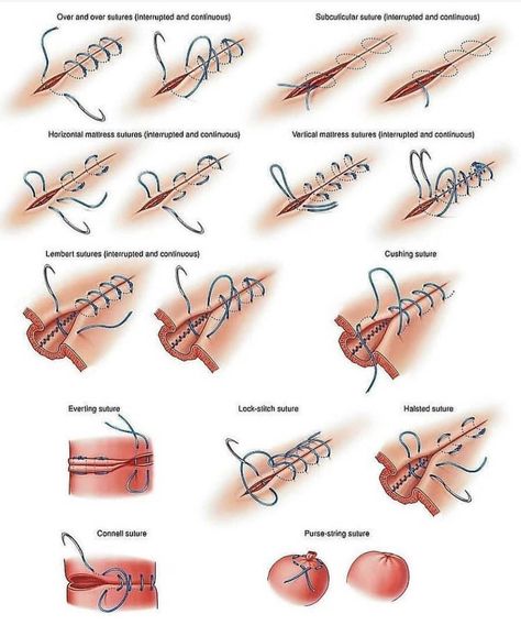 MEDICAL LIFE’s Instagram profile post: “Different types of suture technique.. . Hit the like button ❤and follow↗️ my page if you like ❤my contant.. .Mention your friends to see…” Stitches Medical, Surgical Stitches, Surgical Technologist Student, Suture Techniques, Vet Tech School, Medical Life, Surgical Suture, Medicine Notes, Surgical Technologist