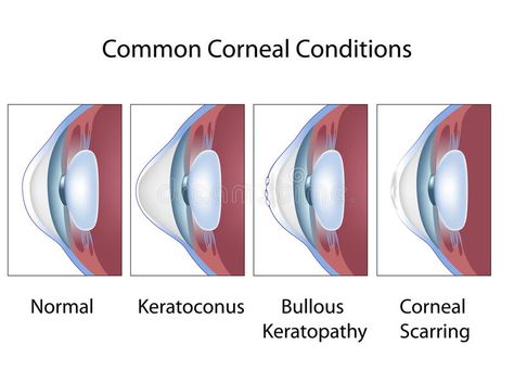 Common corneal conditions. Common diseases of human eye cornea #Sponsored , #sponsored, #ad, #corneal, #eye, #cornea, #conditions Corneal Abrasion, Corneal Transplant, Vision Eye, Eye Doctor, Blender 3d, Diet Tips, Eye Care, Cool Eyes, Biology