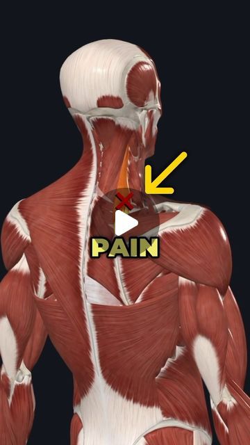 Dr. Adam McCluskey PT, DPT on Instagram: "❌This small muscle could be causing your neck and shoulder pain! (Full Program @theptinitiative Bio Link)
—
There is a small muscle that connects the shoulder blade to the neck, and can be really problematic if it gets overactive and tight.
—
It’s called the Levator Scapulae and it is a common source of neck pain and shoulder blade movement problems.
—
This muscle helps you elevate your shoulder blade, and bend your neck to the side, but can limit your ability to lift your arm overhead optimally if it’s restricted.
—
To begin fixing this issue I recommend doing this active Levator Scapulae release technique with a lacrosse ball to decrease the tonicity and tightness of this muscle.
—
Then we need to actively reinforce this new position by training Scapula Pain, Shoulder Blade Muscles, Neck Spasms, Levator Scapulae, Muscles Of The Neck, Neck Muscles, Muscle Imbalance, Body Exercises, Neck Pain Relief