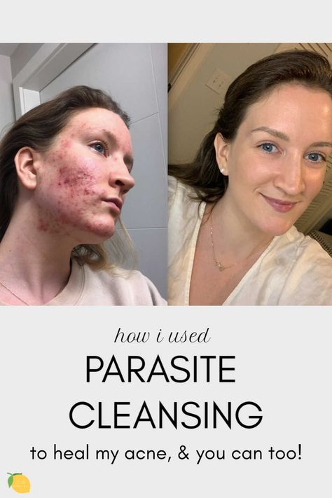 Painful Acne, Skin Parasites, Forehead Acne, Parasite Cleanse, Severe Acne, Types Of Acne, Cystic Acne, Acne Remedies, Skin Care Acne