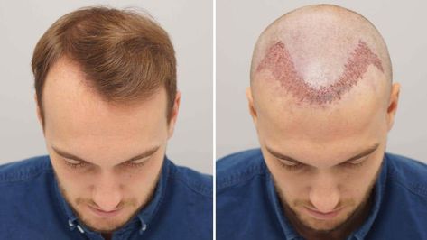 no laser hair transplants!! Female Hair Transplant, Hair Transplant Women, Hair Transplant Cost, Hair Transplant Procedure, Pelo Anime, Fue Hair Transplant, Hair Transplant Surgery, Best Hair Transplant, Hair Clinic