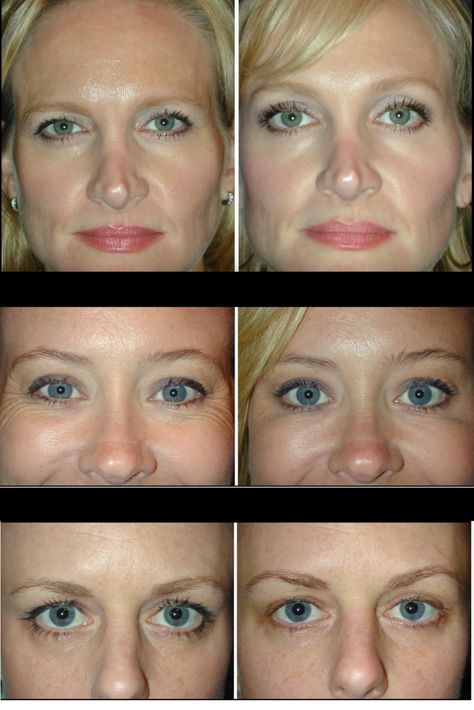 Before you go under the knife for sagging eyebrows, Botox might be just the answer you need!  Learn how you can use Botox to safely lift in your brow in this Medical Minute. Brow Lift Botox Before And After, Eyebrow Lift Before And After, Botox For Eyebrow Lift, Eyebrow Botox Lift, Eyelid Lift Before After, Botox Eyebrow Lift Before And After, Brow Lift Before And After, Brow Lift Botox Eyebrows, Eyebrow Lift Botox Before And After