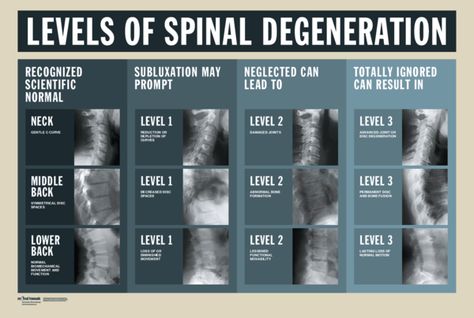 Levels of Spinal Degeneration Backache Remedies, Spine Images, Severe Neck Pain, Spinal Degeneration, Occipital Neuralgia, Human Body Facts, Spinal Fusion, Diagnostic Imaging, Practical Nursing