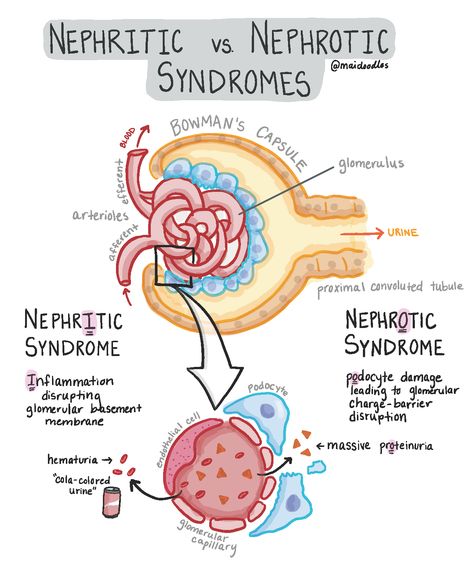 No Time for Kidney-ing Around: Nephritic vs Nephrotic Syndromes | maidoodles Nephritic Syndrome, Nephrotic Syndrome, Medical Mnemonics, Urinary System, Medicine Studies, Nursing Mnemonics, Nursing Student Tips, Medical Student Study, Nursing School Survival