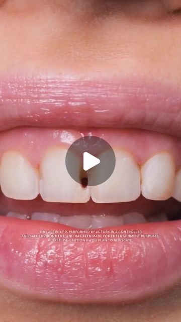 5-Minute Crafts on Instagram: "Composite veneers! How to restore a smile in one go. #hollywoodsmile #veneers #compositeveneers #beautymakeover #dentistry" Composite Veneers Before And After, Veneers Teeth Styles, Veneers Before And After, Composite Veneers, Veneers Teeth, Porcelain Veneers, Restorative Dentistry, Beauty Makeover, Dental Veneers