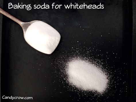 How to get rid of Whiteheads in 5 minutes? - Candy Crow Whiteheads On Chin, Whiteheads Remedy, Shoulder Acne, Baking Soda Scrub, Baking Soda Face Mask, Face Mask For Acne, Mask For Acne, Baking Soda Face, Acne Face Mask