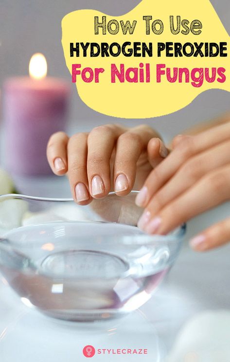 Nail Remedies, Fingernail Fungus, Nail Fungus Remedy, Nail Infection, Fungal Nail, Toenail Fungus, Fungal Infection, Nail Fungus, Hydrogen Peroxide