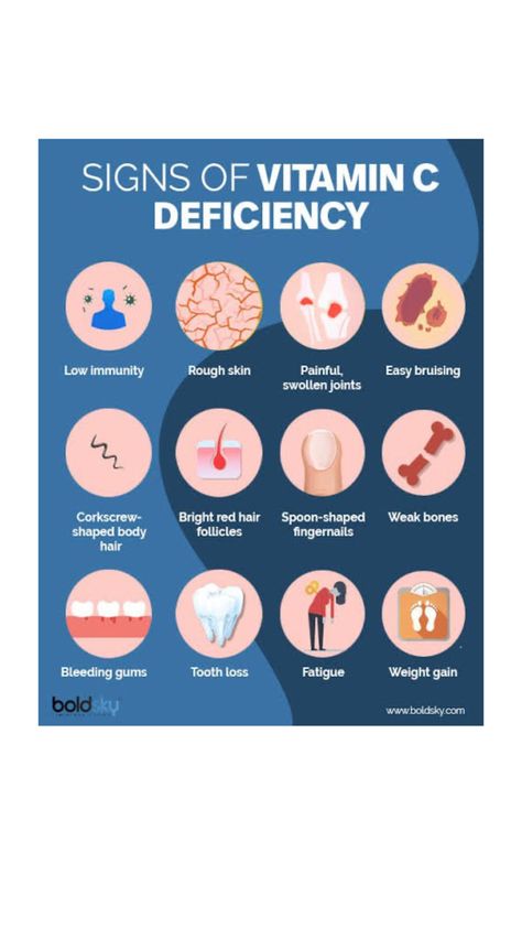 A major vitamin C deficiency (consuming less than 7mg per day, which equates to around one segment of orange, for more than 4 weeks) can result in scurvy Vitamin C Deficiency, Bright Red Hair, Rough Skin, Health Problems, Weight Gain, Vitamin C, Red Hair, Gum, Vitamins