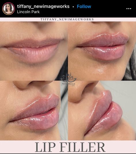 Bow Shaped Lips Filler, Lip Filler Cupids Bow, 1 Syringe Lip Filler Before And After, Hip Filler, Bow Shaped Lips, Lip Injections Shapes, 0.5 Ml Lip Filler Before And After, Lip Filler Shape Ideas, Natural Lip Fillers