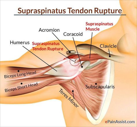 Supraspinatus Muscle, Shoulder Anatomy, Shoulder Surgery, Human Body Anatomy, Muscle Anatomy, Medical Anatomy, Rotator Cuff, Body Anatomy, Anatomy And Physiology