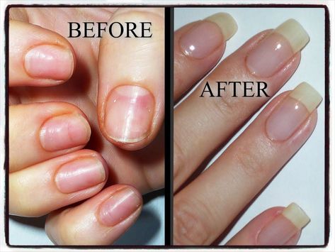 My Nail Journey-Growing Natural Nails after damage from Acrylics/Gels (+... Great natural remedies for healthy nails. Natural Looking Acrylic Nails, Nails After Acrylics, Nails Yellow, Damaged Nails, How To Grow Nails, Nail Growth, Nails Polish, Get Nails, Strong Nails