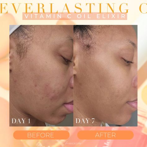 Okayyyy Everlasting C Melasma, fine lines, dull-aging skin Let's C if it it can help you!! Vitamin C Serum Before And After, Getting Better, Vitamin C Serum, Aging Skin, Golden Hour, Vitamin C, Say Hello, Healthy Skin, No Worries