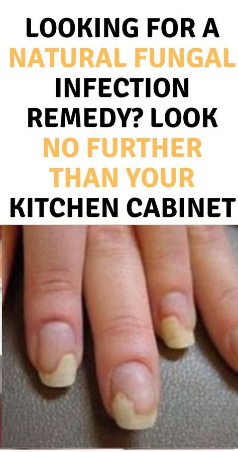 Eliminate Toenail Fungus in Days with This One-Tablespoon Miracle Solution - It Really Works Fungal Infection Remedies, Toenail Health, Toenail Fungal Infection, Nail Remedies, Natural Antifungal, Nail Fungus Remedy, Nail Infection, Fungal Nail, Nails Today