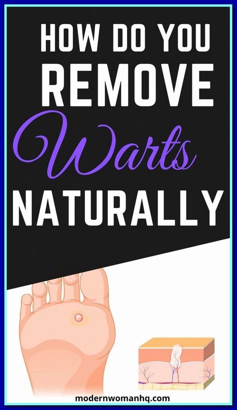 Board name What Causes Warts, Remove Warts, Get Rid Of Warts, Home Remedy For Cough, Cold Sores Remedies, Weight Changes, Natural Sleep Remedies, Natural Cold Remedies, Cold Home Remedies