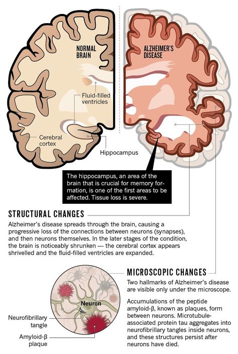 Alzheimers Brain Image, Alzheimers Disease Brain, Alzheimer’s Disease, Brain Atrophy, What Is Intelligence, Alzheimers Disease, Neurological System, Alzheimer Care, Psychology Notes