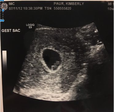 Our baby was bigger from last time, heart beat was great, and no signs of bleeding. We actually got to see our baby progress for the first time! Baby Progress, Heart Beat, Our Baby, In A Heartbeat, First Time, The First, My Saves, Signs, Quick Saves