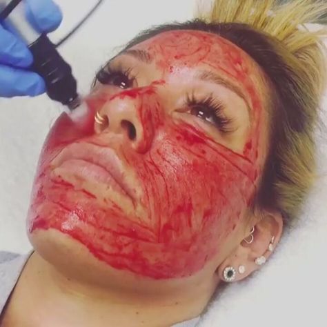 Beauty Insider on Instagram: “Via @thisisinsiderfitness: The vampire facial is a bloody good way to rejuvenate your skin. 💉 #beautyinsider @silviambeauty” Vampire Facial, Facial Wrinkles, Small Faces, Beauty Inside, The Vampire, Beauty Trends, Your Skin, Healthy Skin, Carnival Face Paint