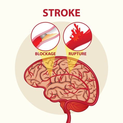 This vector or illustration image is suitable for health design for the stroke disease. The design can be for posters, flyers, brochures, appeals, prevention, displays, signs and billboards. #health #stroke #strokeday #vector #illustration #strokeblockage # strokerupture #medicine Brain Illustration, Vegan Probiotics, Foot Reflexology Massage, Reflexology Massage, Foot Reflexology, Healing Touch, Heart Illustration, Health Design, Illustrator Artist