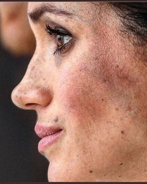 Meghan Markle Nose Job, Meghan Markle Plastic Surgery, Extreme Plastic Surgery, Princ Harry, Facial Bones, Bad Makeup, Princess Meghan, Prince Harry And Megan, Bone Structure