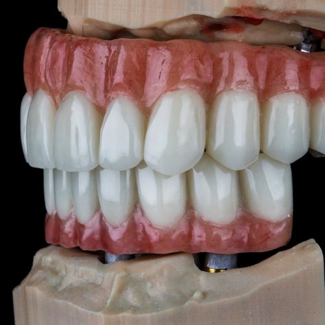 We pride ourselves on delivering personalized solutions tailored to meet the unique needs of every patient, ensuring a natural look and feel. With a commitment to excellence and no hidden fees, our full arch dental implants provide a durable and aesthetically pleasing solution for a complete smile makeover.   #ReliableDentalLab #DentalLab #DentalImplants #AllOnFour #FullArch Dental Animation, Medical Animation, Smile Makeover, Dental Lab, Dental Implants, Natural Look, Aesthetically Pleasing, Arch, Medical