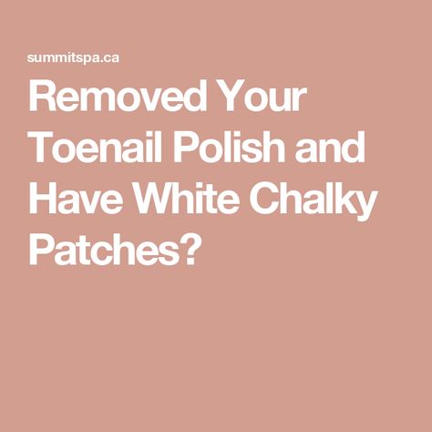 Removed Your Toenail Polish and Have White Chalky Patches? How To Get Rid Of White Spots On Nails, White Patches On Toenails, Nail Bed Damage, White Spots On Toenails, White Spots On Nails, Remove Shellac Polish, Toenail Problems, Toenail Removal, Nail Discoloration