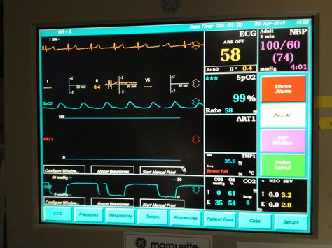 Patient Monitoring during Anesthesia Hemodynamic Monitoring, Anesthesia School, General Anesthesia, General Anaesthesia, Iv Fluids, Heart Monitor, Heart Function, Vital Signs, Blood Pressure Monitor