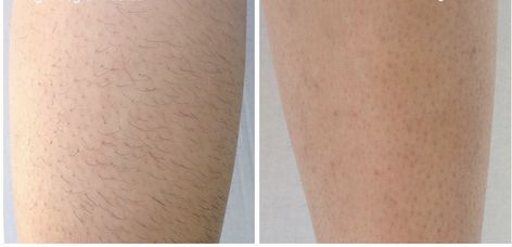 Spring is right around the corner! Start your Spring off right with our Laser Hair Removal! Here we have our before and after with only just 5 sessions!!!   #Lasting #Affordable #Safe #Effective #Results   Schedule your appointment with us today! Cellphone: (575)914-1948 Office: (575)622-4032 Hair Laser, Permanent Laser Hair Removal, Laser Hair Reduction, Skin Center, Depilatory Cream, Laser Removal, Dr J, Hair Removal Devices, Hair Removal For Men