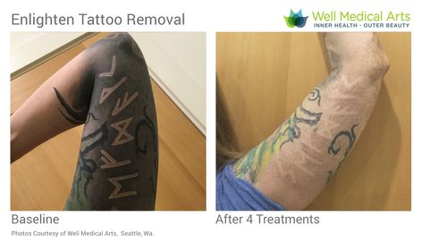 Go Tattoo, Tattoo Removal Cost, 12 Tattoos, Green Tattoos, Web Tattoo, Famous Tattoos, Omerta Tattoo, Healing Tattoo, Laser Tattoo