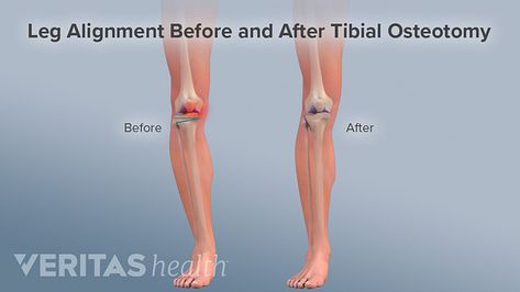 A knee osteotomy can change bone alignment so that the mechanical axis passes though the center of the knee and weight is more evenly distributed. This can help avoid further joint degeneration. Bow Legged Correction, Knock Knees, Homemade Body Care, Bow Legged, Knee Surgery, Health Trends, Feeling Happy, Knock Knock, Workout Videos