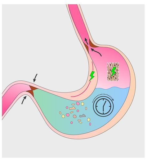 Gastroperisis Diet, Gastroperisis Diet Food List, Gastroperisis Symptoms, Gastroperisis Quotes, Gastro Paresis Diet, Gastroperisis Diet Smoothies, Gastroperisis Diet Recipes, Geophagus Tapajos, Gastric Problem