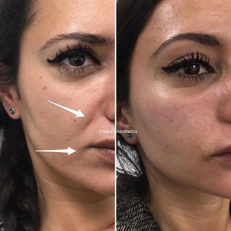 Face Injections, Cosmetic Fillers, Cheek Bones, Rhinoplasty Nose Jobs, Face Fillers, Face Surgery, Pretty Nose, Cheek Fillers, Beauty Procedures