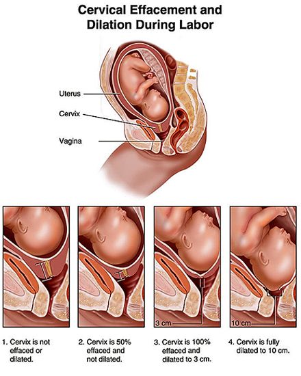 Bishop Score, Cervical Effacement, Dilation And Effacement, Phases Of Labor, Labor Doula, Ob Nurse, Birth Education, Ob Nursing, Childbirth Education