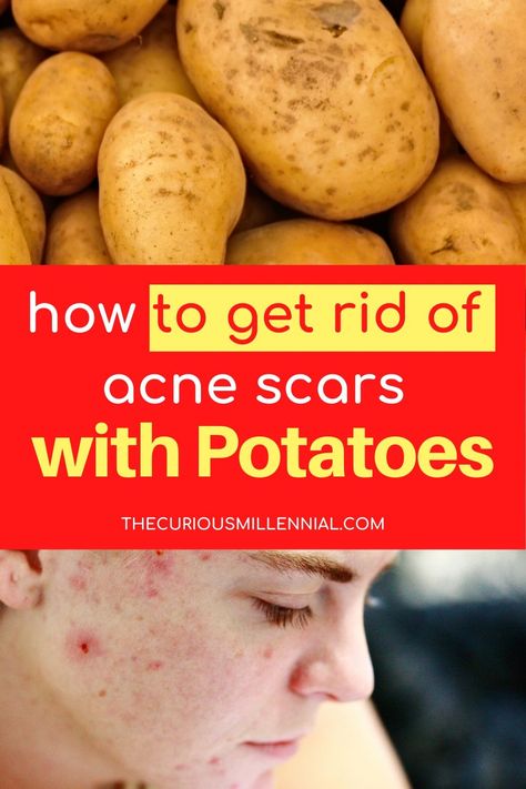 Potatoes and potato juice are known to significantly lighten pigmentation and dark acne spots. These easy potato face mask recipes lighten uneven skin tone, fade acne scars and leave you with more even, bright and radiant skin. Nothing can work better than potato to even out skin tone, brighten it up and lighten the uneven marks on the skin. Below is a recipe for DIY potato mask for acne scars along with its benefits. #beautyhacks #skintreatments #naturalskincare #skincaretips Potato For Acne, Potato For Skin, Potato Face Mask, Personal Cleanliness, Potato Face, Acne Scar Mask, Mask For Acne, Mask Recipes, Potato Juice