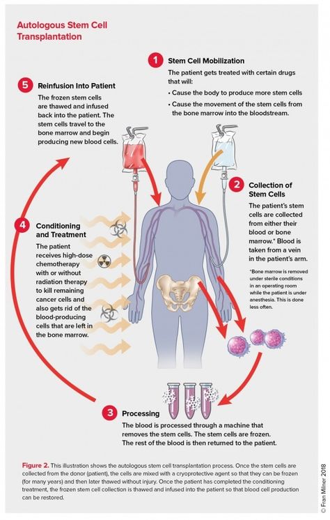 Stem Cell Transplantation | Autologous Stem Cell Transplantation | LLS Stem Cell Research, Journal Lists, Type Treatments, Bone Marrow, The Patient, Types Of Cancers, Blood Cells, Stem Cells